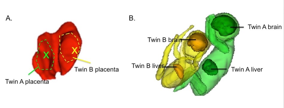 You are currently viewing Why One Twin is Often Smaller than the Other