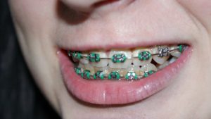 Read more about the article Oral Care Tips for Kids with Braces
